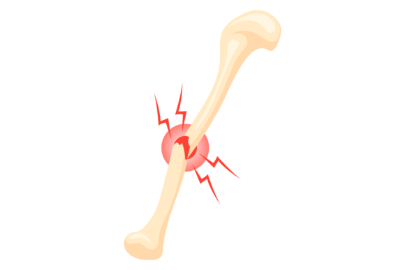 Broken Bone Icon: Graphics and Illustrations Review